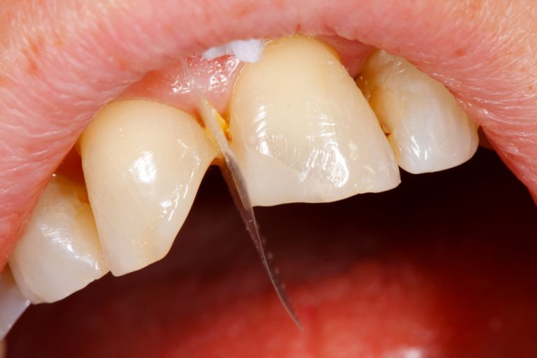 broken tooth being filled with composite filling materal